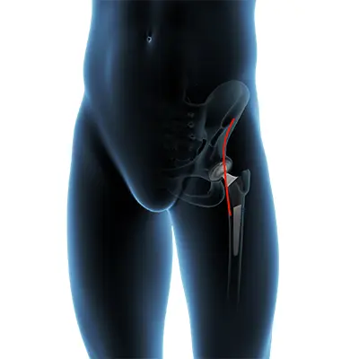Anterior Hip Replacement