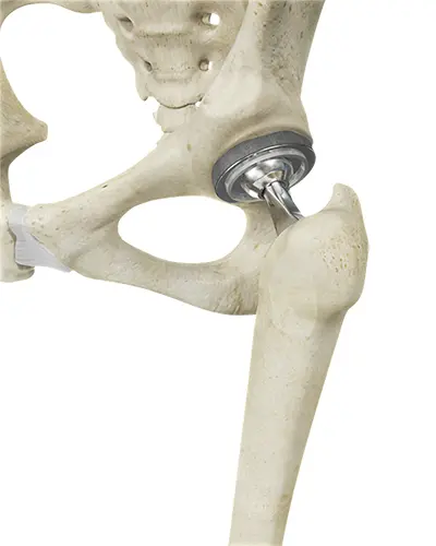 Bikini Hip Replacement Procedure - Benjamin Domb MD