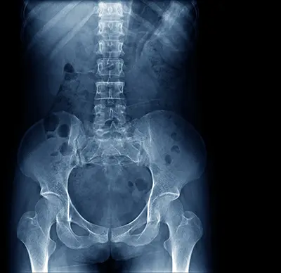 Hip Replacement - Benjamin Domb MD