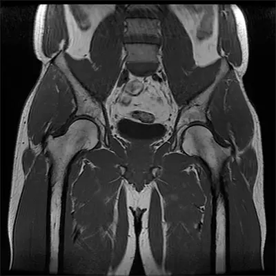 Diagnosis Snapping Hip