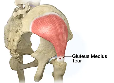 Endoscopic Hip Tendon Repair - 2 - Educational Photo