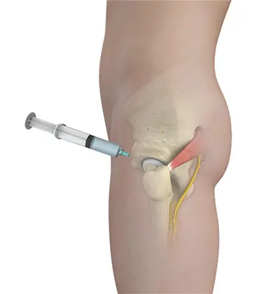 Treatment Options - Benjamin Domb MD
