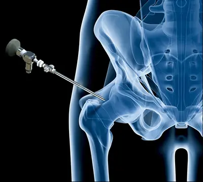 Surgical Treatments Ischiofemoral Impingement - Benjamin Domb MD