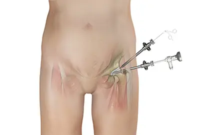 Indications of Hip Arthroscopy - Benjamin Domb MD