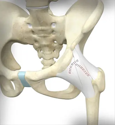 Surgical Treatment Ehlers Danlos Syndrome - Benjamin Domb MD