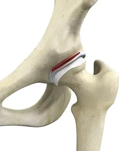 Arthroscopic Labral Repair & Reconstruction - 2 - Educational Photo