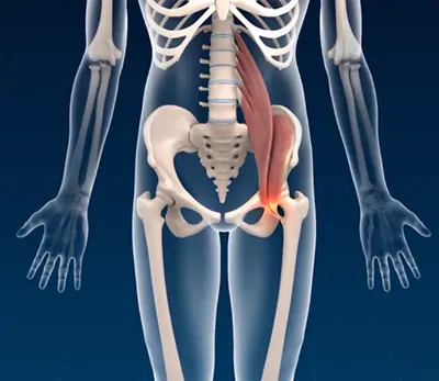 Cortisone Iliopsoas