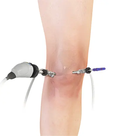 ACL Reconstruction - 3 - Educational Photo