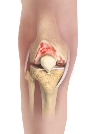 Indications for Total Knee Replacement - Benjamin Domb MD