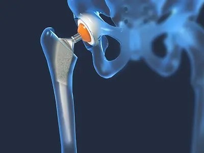 Traditional Total Hip Replacement - Benjamin Domb MD