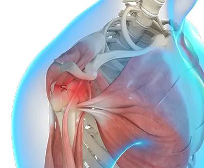 Rotator Cuff Tear - 1 - Educational Photo