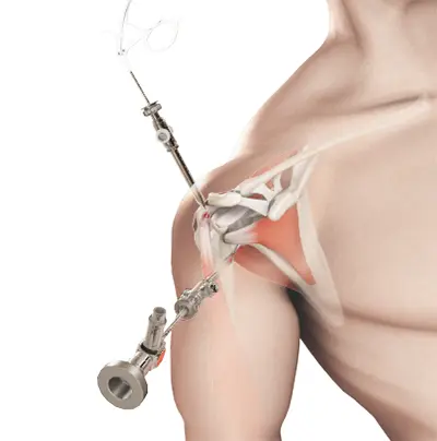 Rotator Cuff Tear - 6 - Educational Photo