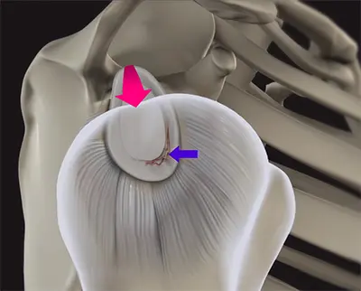Shoulder Dislocations