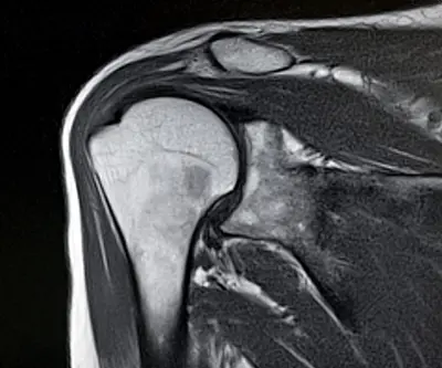  Shoulder Replacement Surgery - Benjamin Domb MD