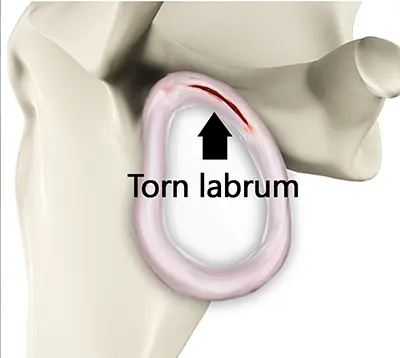 Shoulder Instability