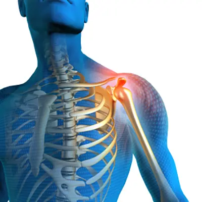 Shoulder Pain - 1 - Educational Photo