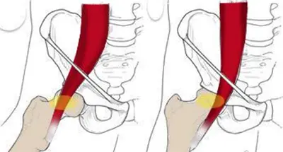 Endoscopic Hip Tendon Repair - 3 - Educational Photo