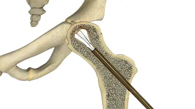 Surgical Treatments of Avascular Necrosis - Benjamin Domb MD