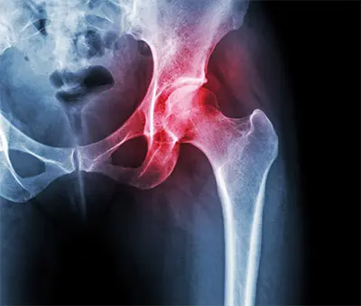 Symptoms ofAvascular Necrosis - Benjamin Domb MD