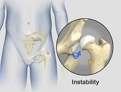 Hip - Benjamin Domb MD