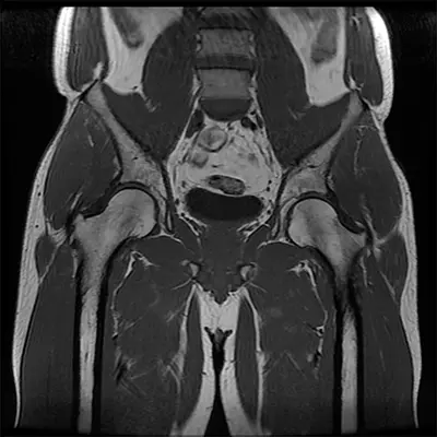 Diagnosis of Ligamentum Teres Tears - Benjamin Domb MD